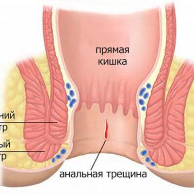 Тріщини прямої кишки: симптоми і лікування